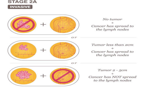 Breast Cancer Hospital In Thane - What Types Of Cancer Are Diagnosed As Stage 2 And 2A Breast Cancer?